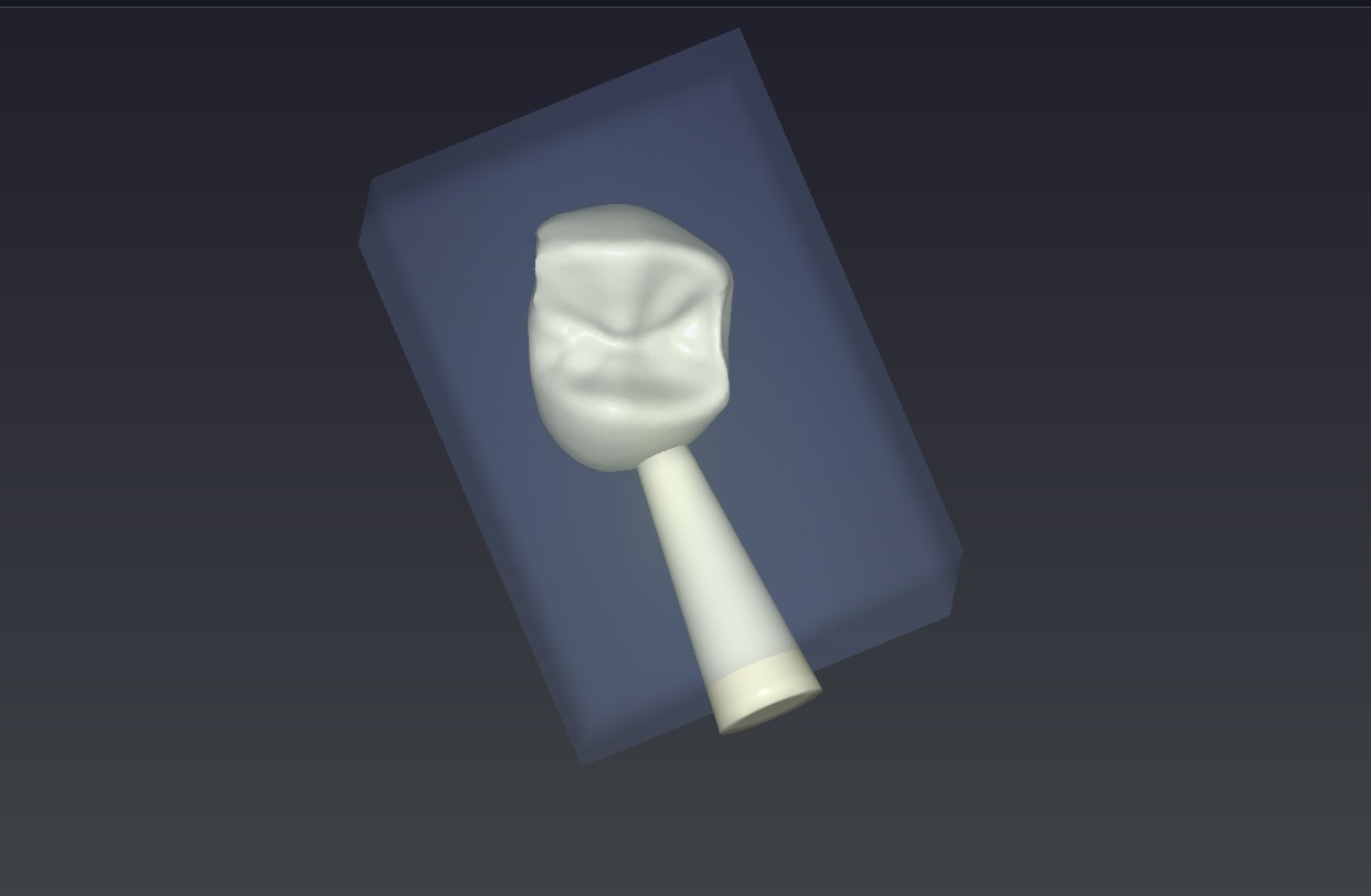 CAD/CAM software screenshot showing in-house crown block design for same-day milling at Richmond Dental Spa — no temporary crowns, no messy impressions required