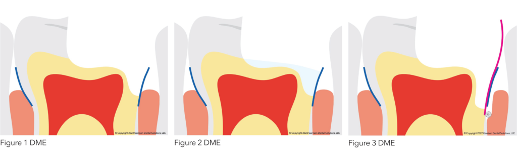 deep margin elevation
