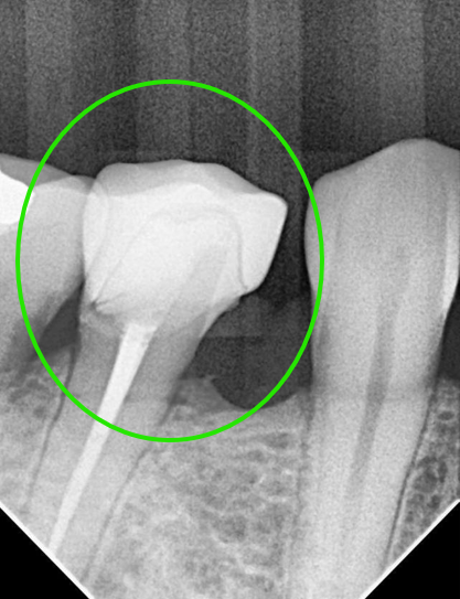 DME & Biological Crown DME & Biological Crown