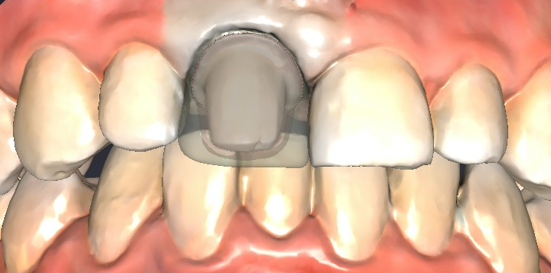 Crown Shadow Crown Shadow