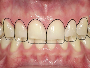 Veneers Design Veneers Design