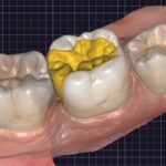 Biomimetic Restoration in Richmond Dental Spa Biomimetic Restoration in Richmond Dental Spa