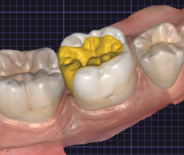 Biomimetic Restoration in Richmond Dental Spa