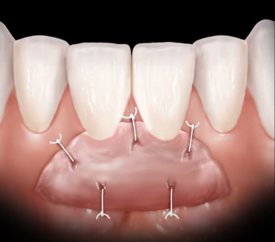 Gingival Graft Gingival Graft