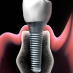 Dental Implant Dental Implant