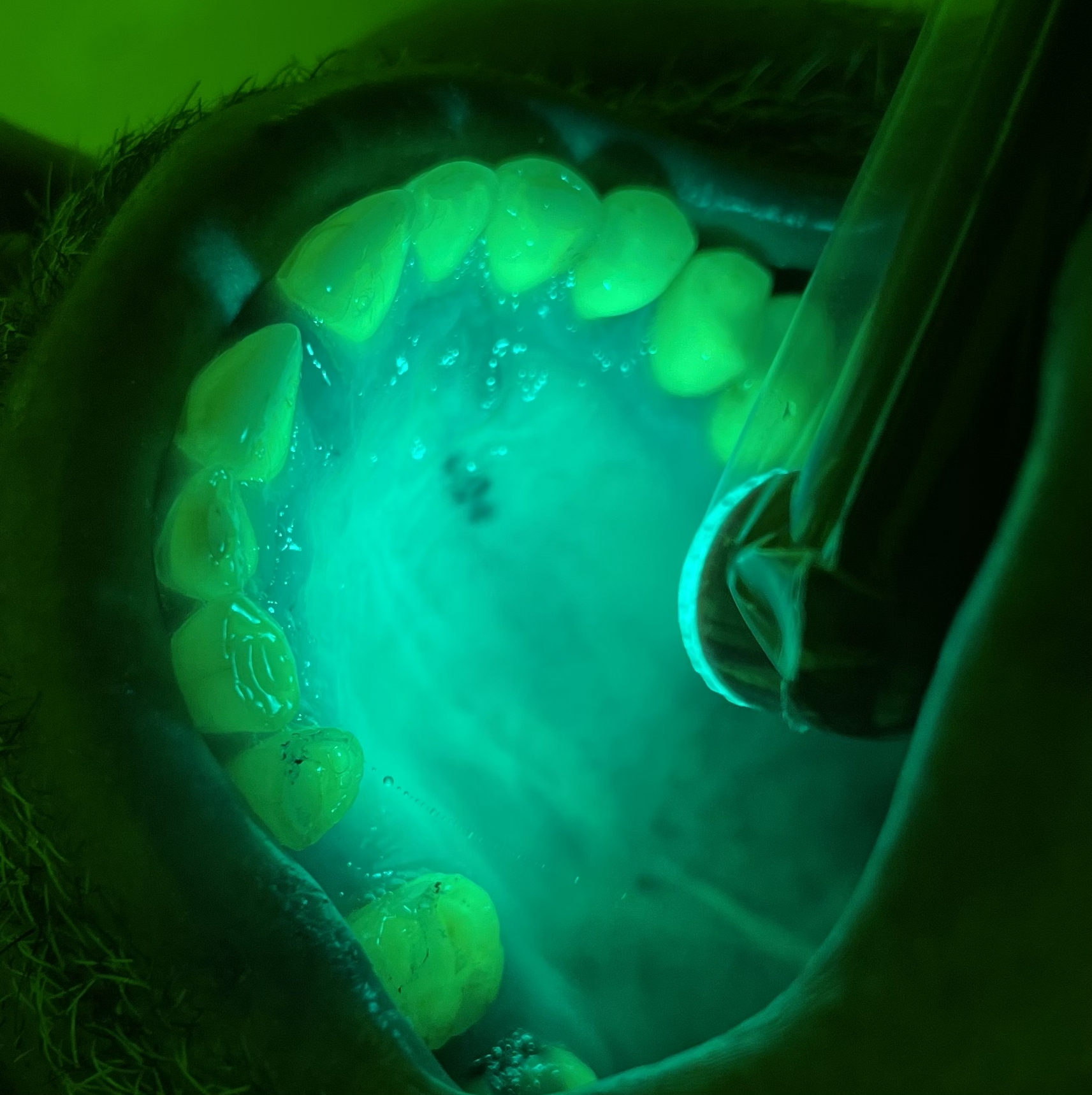 Goccles fluorescence oral lesion screening showing upper arch under blue light — early tissue anomaly detection at Richmond Dental Spa