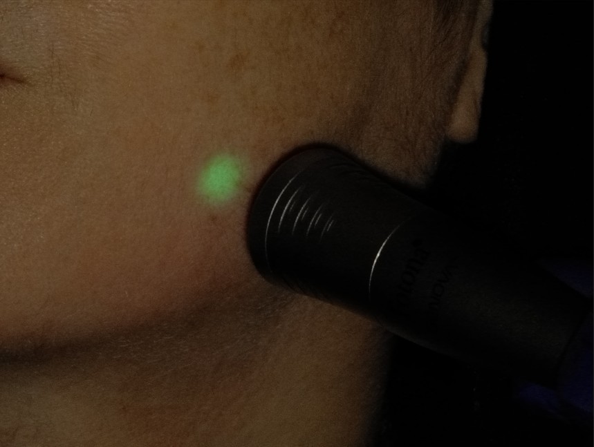 Genova handpiece in brush mode for photobiomodulation surface therapy