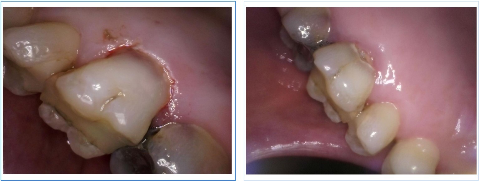 Laser Gum Treatment