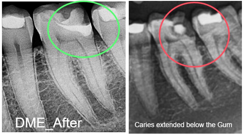 Tooth before and after Deep Margin Elevation restoration at Richmond Dental Spa