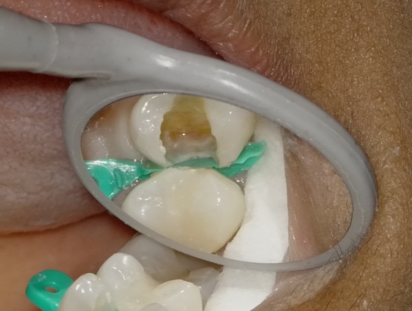 Microscopic view of a specially designed wedge used during Deep Margin Elevation at Richmond Dental Spa