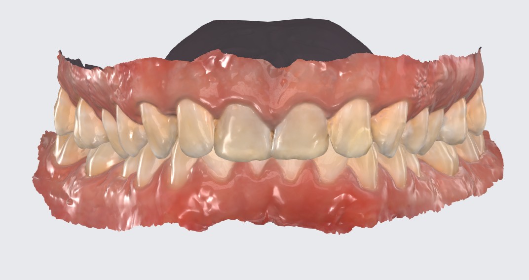 Deep bite — upper teeth excessively overlapping lower teeth