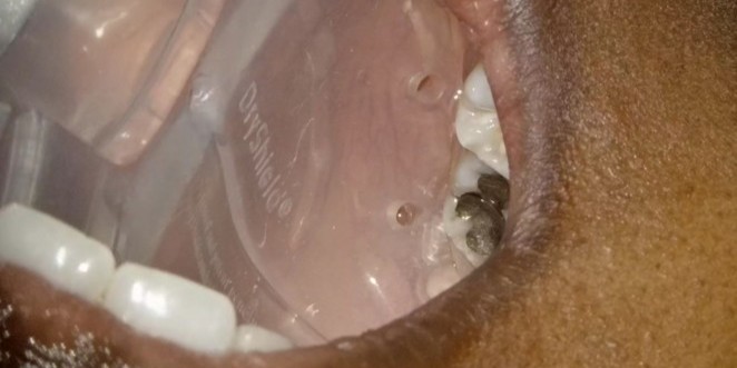 DryShield isolation system used during SMART Protocol safe mercury amalgam removal at Richmond Dental Spa
