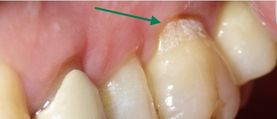 Exposed dentin at tooth neck after Fotona laser desensitization treatment at Richmond Dental Spa