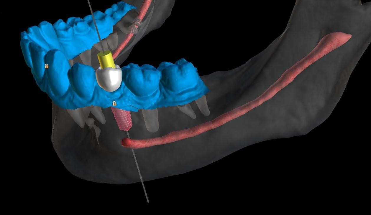 3D guided implant surgical plan at Richmond Dental Spa showing planned implant position with safety distance from the inferior alveolar nerve canal