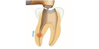 Laser-enhanced root canal disinfection at Richmond Dental Spa