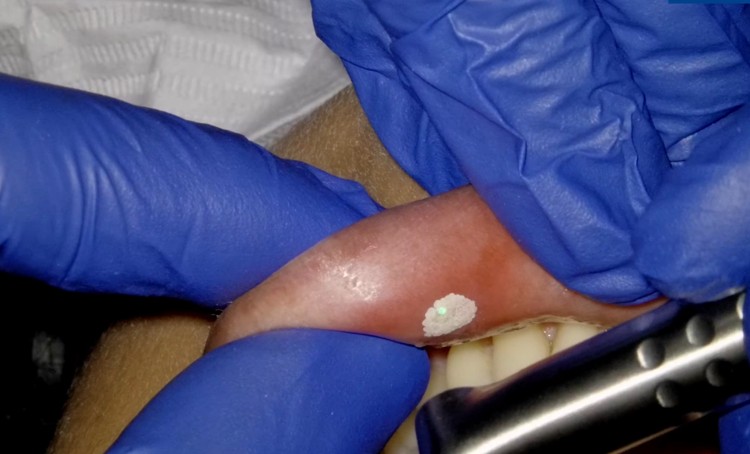Laser Bandage treatment for cold sores and oral ulcers at Richmond Dental Spa