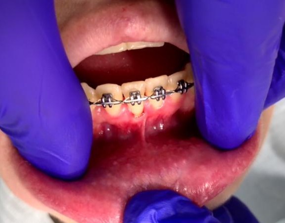 Laser tongue and lip tie release frenectomy procedure at Richmond Dental Spa