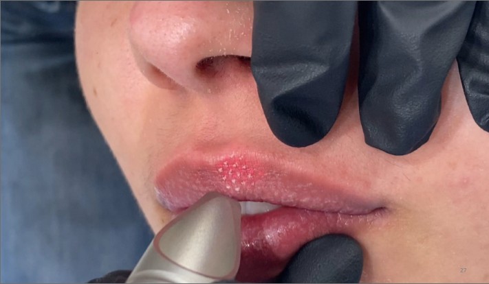 LipLase Fotona laser lip plumping treatment at Richmond Dental Spa — non-injectable natural lip enhancement