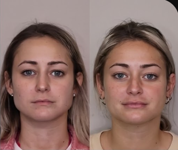 Patient 2 — before and after masseter hypertrophy reduction with therapeutic neurotoxin at Richmond Dental Spa