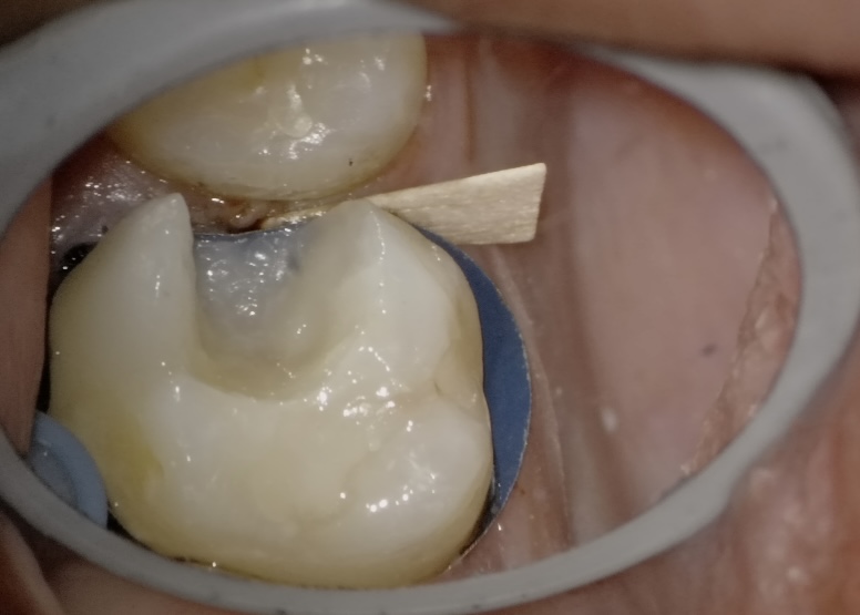Microscopic view of matrix band placement during Deep Margin Elevation restoration at Richmond Dental Spa