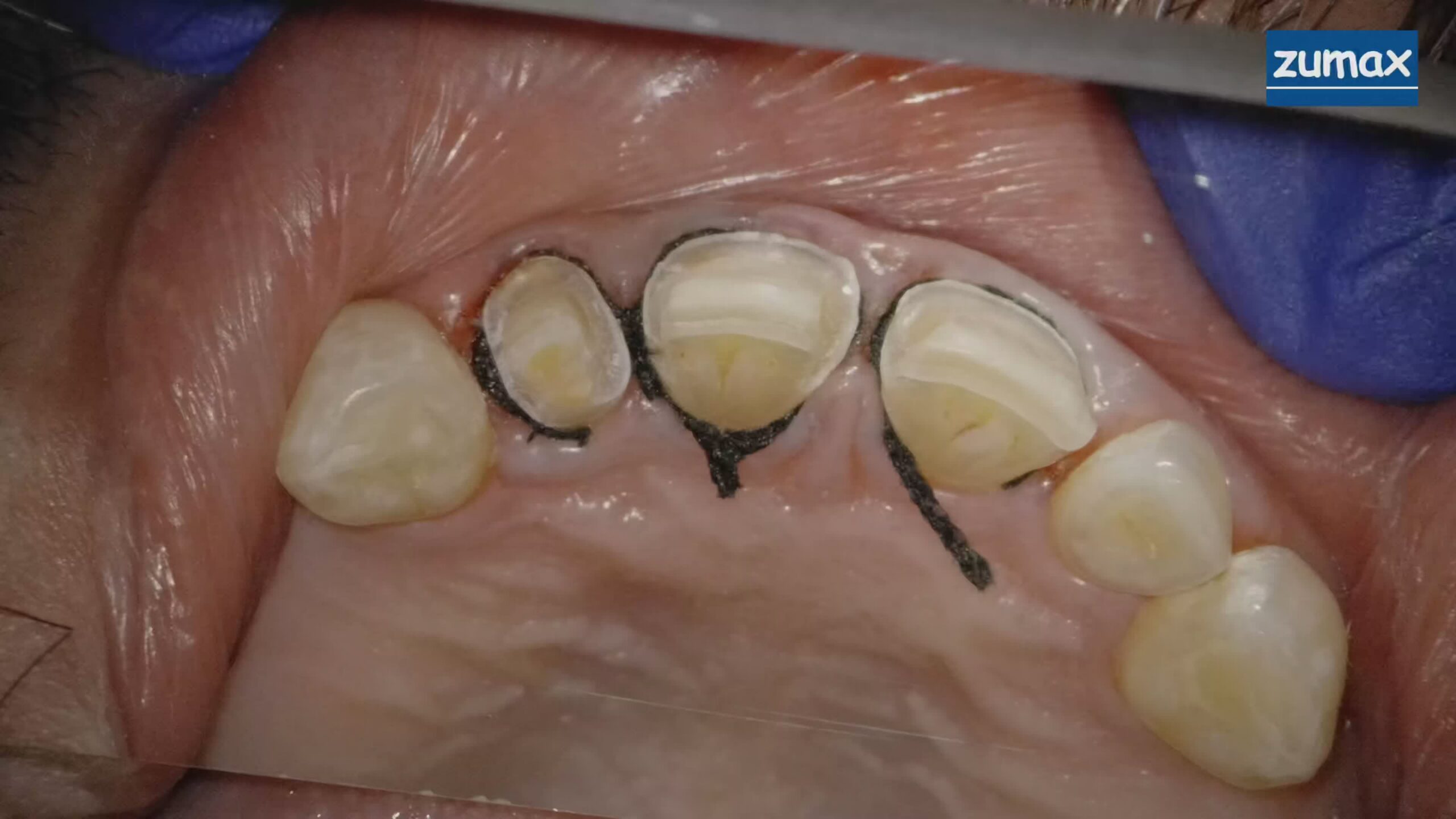 Minimally invasive partial crown restoration at Richmond Dental Spa