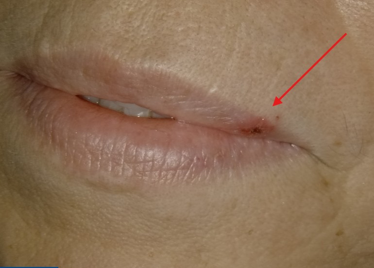Cold sore (herpes labialis) on the lip before laser bandage treatment at Richmond Dental Spa