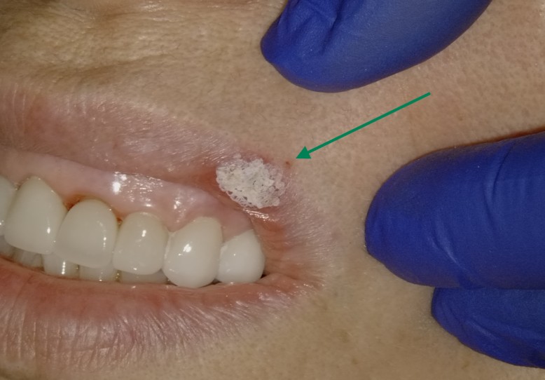 Er:YAG laser bandage being applied to a cold sore lesion at Richmond Dental Spa