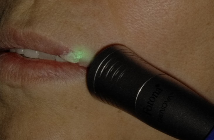 Nd:YAG Genova handpiece applying photobiomodulation to a cold sore after Er:YAG laser bandage treatment at Richmond Dental Spa