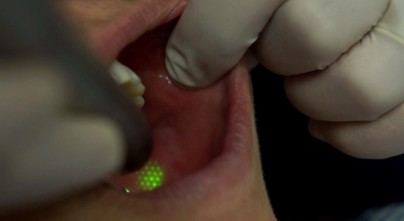 SmoothLase Fotona laser treatment at Richmond Dental Spa — collagen stimulation and tissue tightening for smile line rejuvenation
