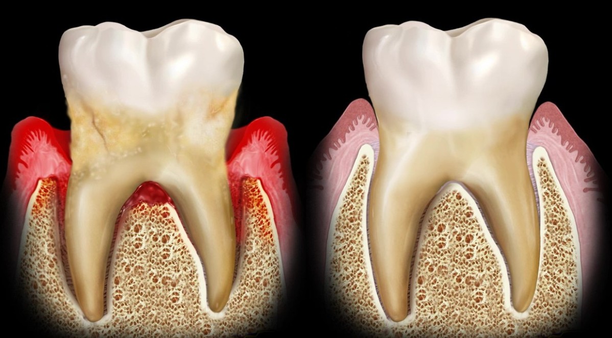 Gum health treatment results at Richmond Dental Spa relevant to halitosis root-cause treatment