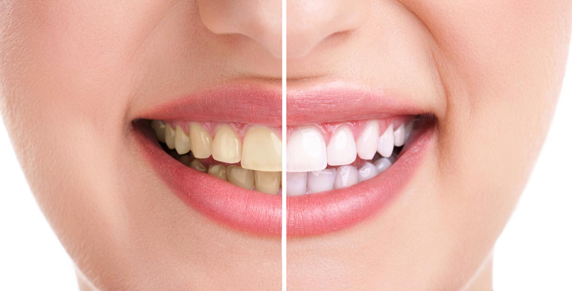 In-office Touchwhite teeth whitening with Fotona laser activation at Richmond Dental Spa