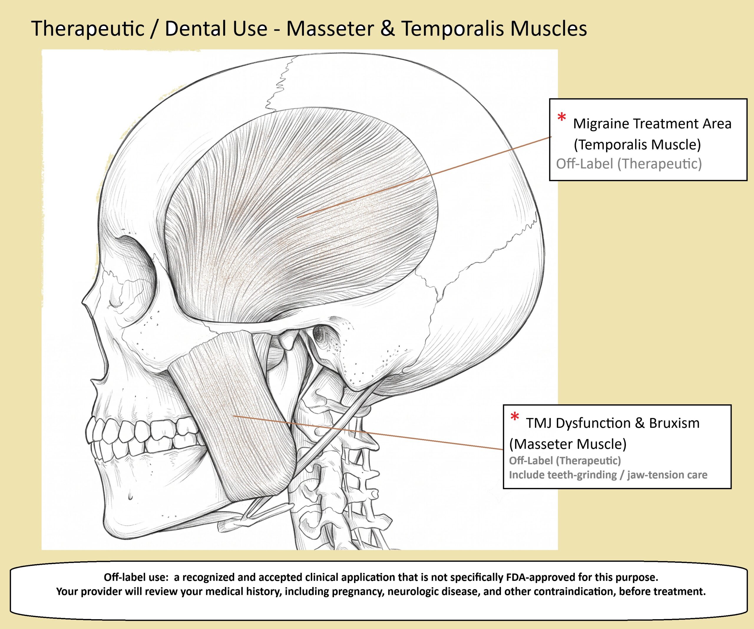 Anatomical diagram of the temporalis and masseter muscles showing the areas treated for TMJ dysfunction, bruxism, and tension-related headaches at Richmond Dental Spa