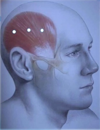Temporalis muscle injectable sites for therapeutic neurotoxin treatment of jaw clenching and TMJ pain