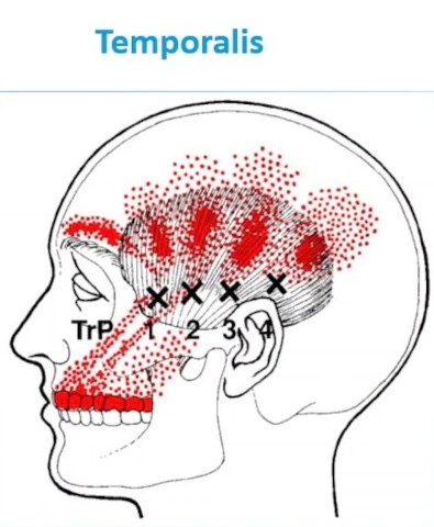 Temporalis muscle trigger point diagram showing referred pain pattern to the upper teeth at Richmond Dental Spa