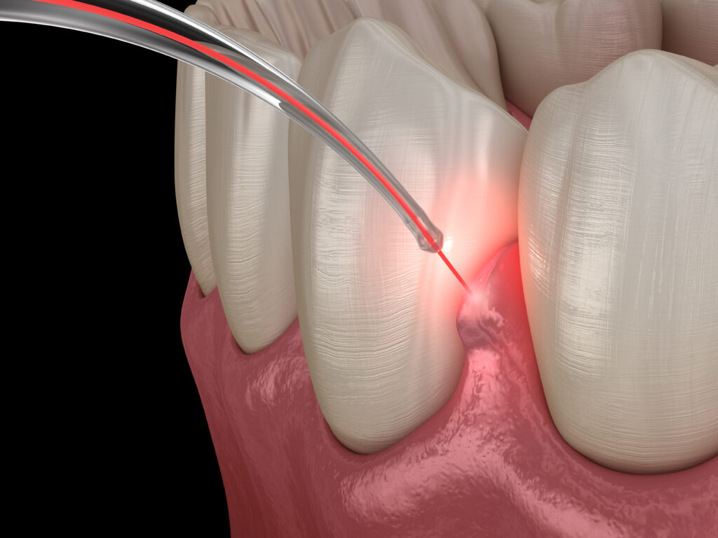 Laser gum recontouring for gummy smile correction at Richmond Dental Spa