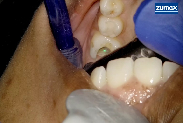 Er:YAG laser cavity preparation in progress at Richmond Dental Spa