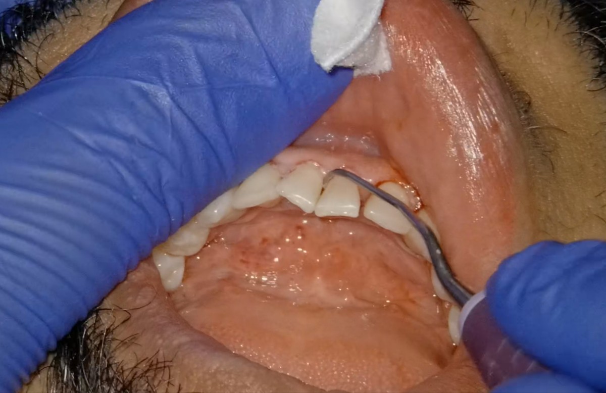 Step 3B