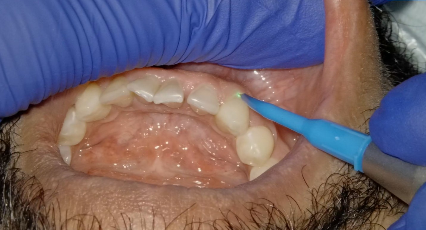 TwinLight Gum Treatment TGT at Richmond Dental Spa — Nd:YAG laser pocket seal and photocoagulation creating a sterile blood clot to seal the periodontal pocket